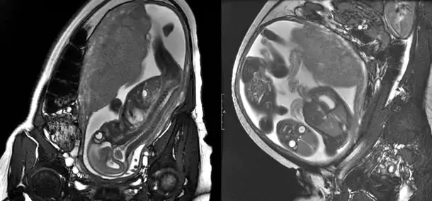 Fetal MRI enables early pediatric health planning