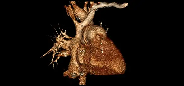 Imaging Improves Care for Fontan Patients