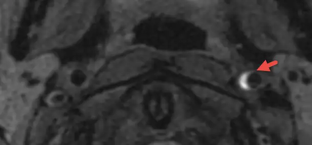 Stroke in Children May Present with More Subtle or Nonspecific Symptoms