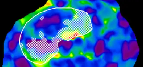 Imaging Children with Cystic Fibrosis