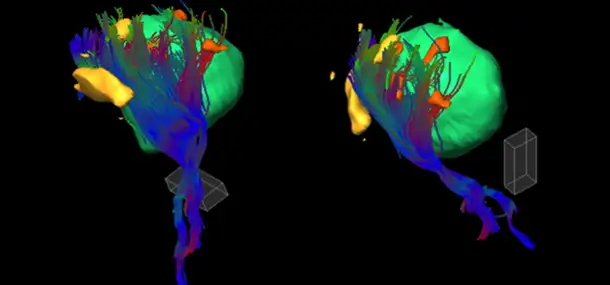 Using MRI to Identify Brain Function