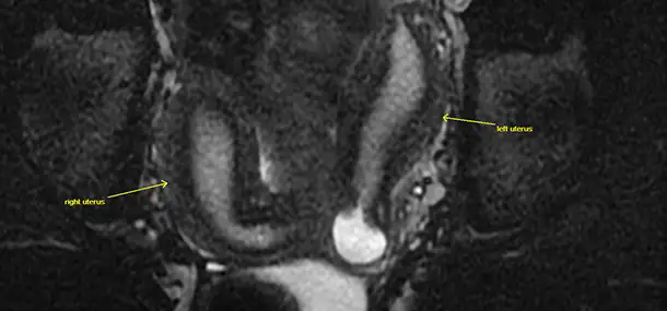 How Anorectal Malformations Affect Girls