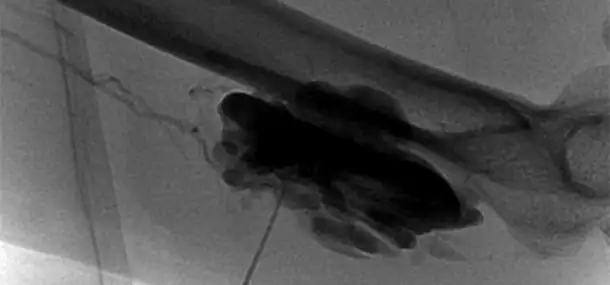 Sclerotherapy for Vascular Malformations