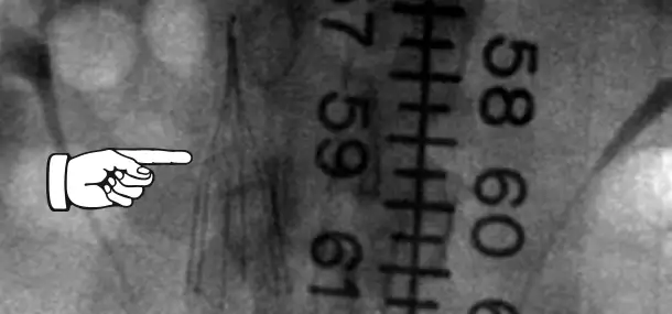 What is Interventional Oncology?