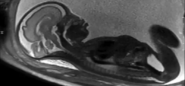 Is MRI safe for my unborn child?