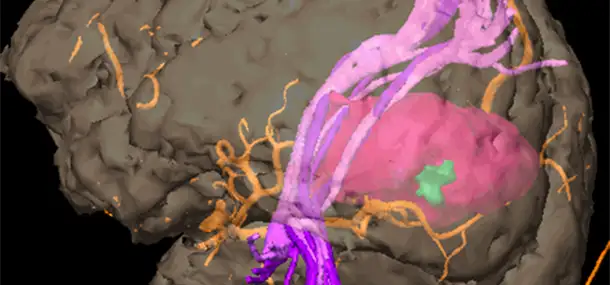 Neurosurgeons and radiologists work together to give your child the best possible outcome