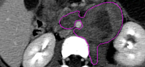 Finding the Best Ways to Measure Neuroblastoma Tumors