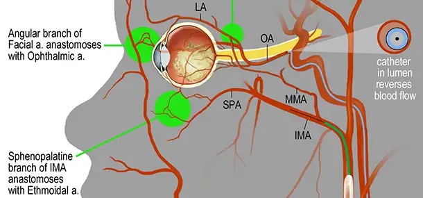 Finding New and Better Ways To Treat Eye Cancer