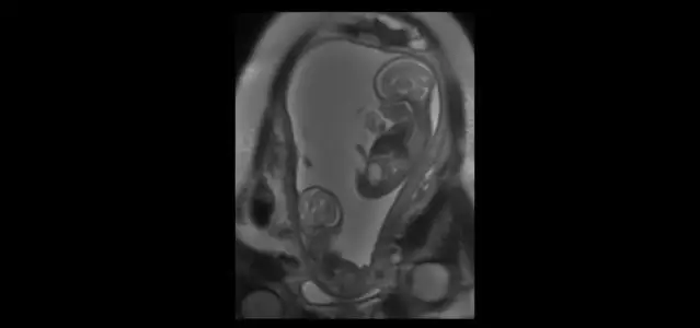 Treating Twin Twin Transfusion Syndrome to Change the Outcome