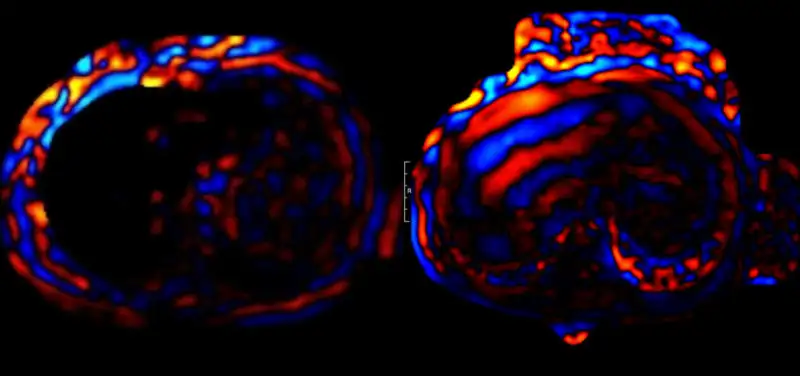 MRI Elastography: New techniques to help patients with liver disease