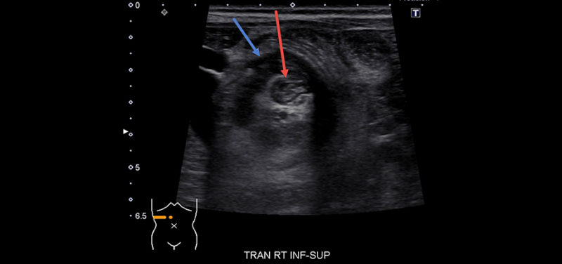 What Is Intussusception?