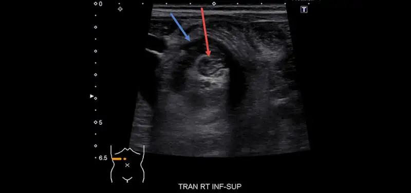 What Is Intussusception?