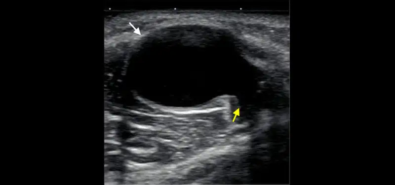 My child has a lump: Why did our pediatrician order an ultrasound?