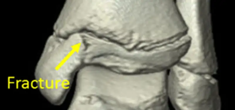 Using Computed Tomography (CT) for Ankle Injuries in Children