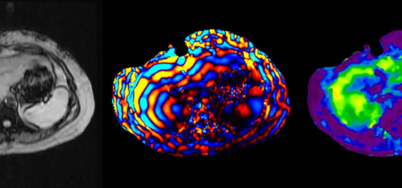 Measuring liver stiffness using MRI