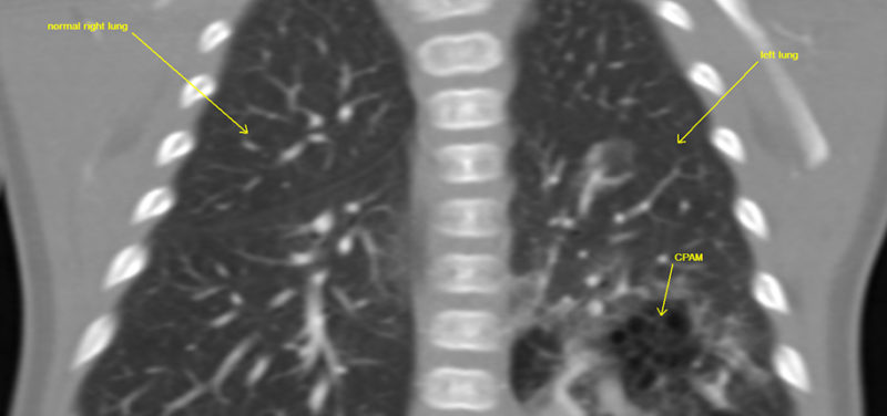 Using Better Radiologic Techniques to Look at Infants with Lung Abnormalities