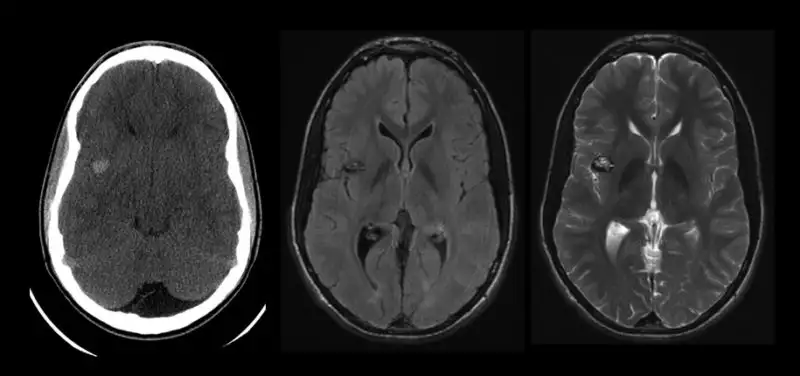 Pediatric Cerebrovascular Center Is One of the Most Experienced in the World