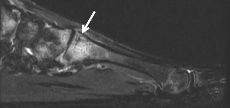 March Fractures
