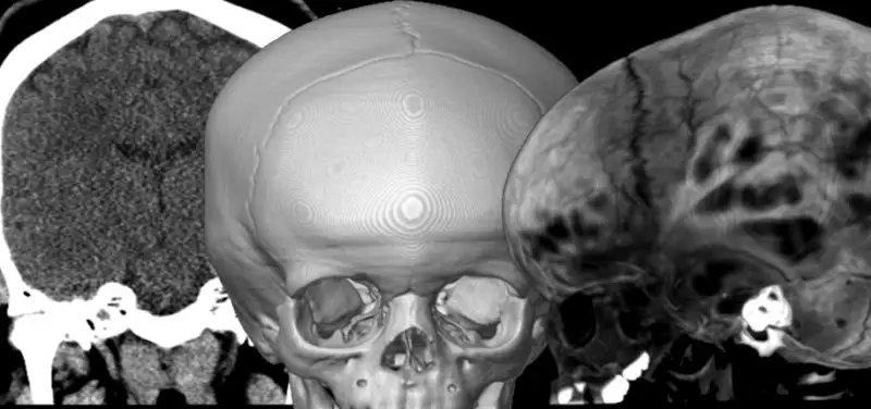 My son has had 3 CT scans. Did the radiation hurt him?