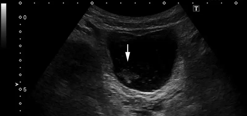 Imaging Urinary Tract Infections in Children