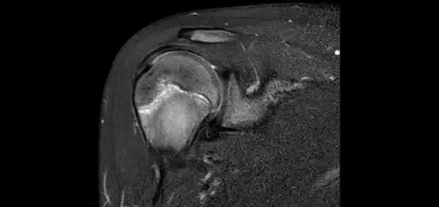 What Is Little League Shoulder?
