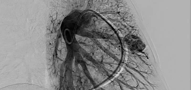 The HHT (Hereditary Hemorrhagic Telangiectasia) Center of Excellence at Cincinnati Children’s