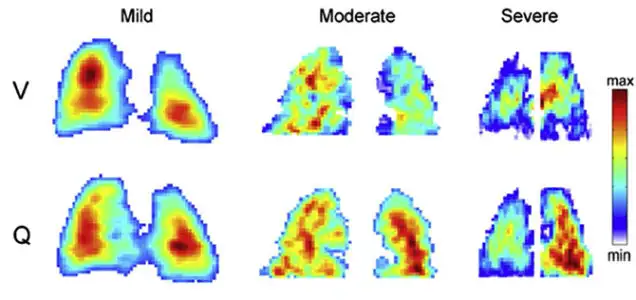 Newer Imaging Techniques for Bronchopulmonary Dysplasia