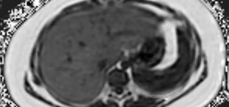 Cincinnati Children’s Radiology Pioneering New Techniques in Diagnosing Liver Disease
