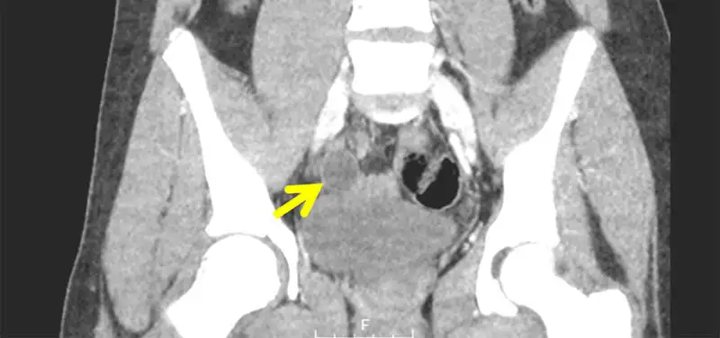 Appendicitis – Then and Now