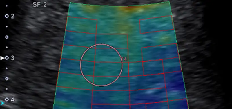 Looking For and Following Liver Disease with Shear Wave Elastography in Ultrasound