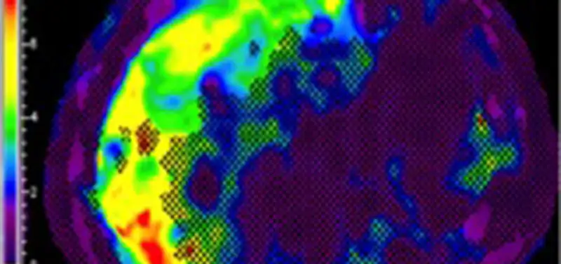 Shortening your breath holds for MR Elastography studies