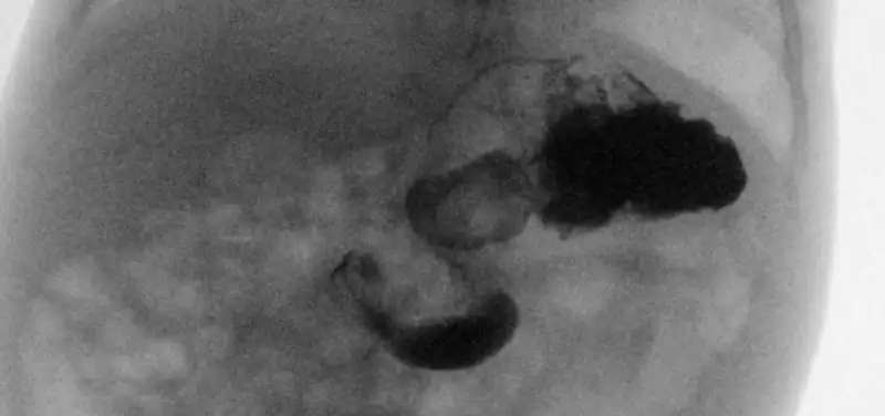 What is Intestinal Malrotation and Volvulus?