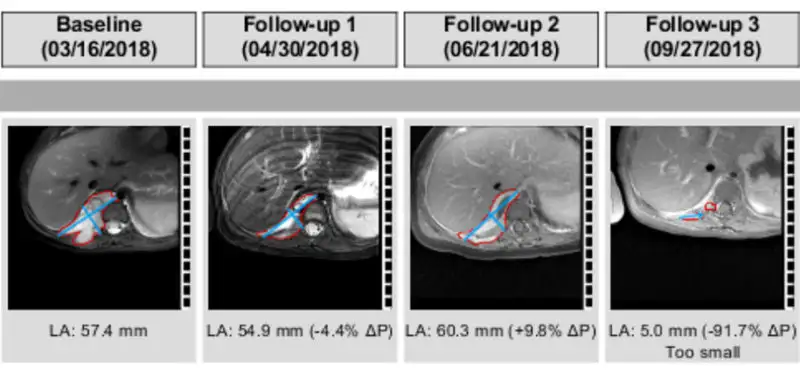 Using a New Tool in Technology to Help Treat Patients with Cancer
