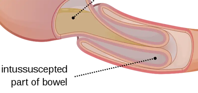 What is Intussusception?