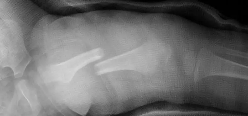 How Do Our Bones Heal After a Fracture?