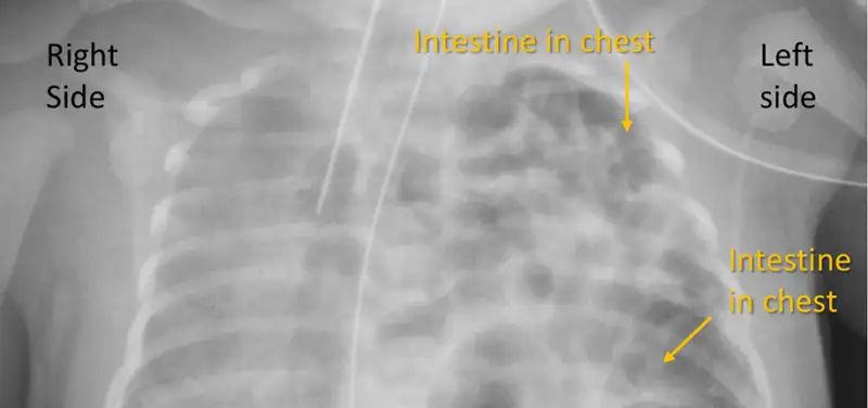 Hernias in kids?