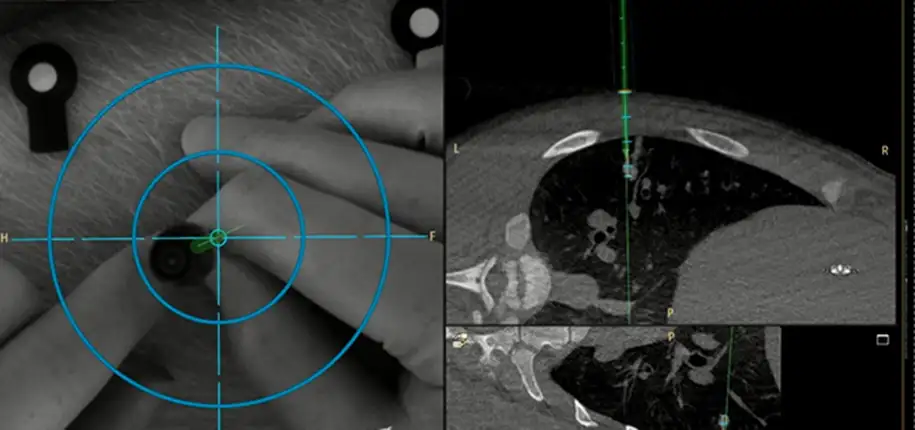 How Interventional Radiologists are using Augmented Reality to help find better ways to treat children