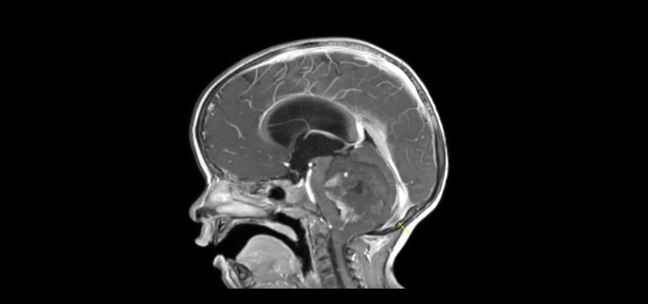 Is MRI Contrast Dangerous?