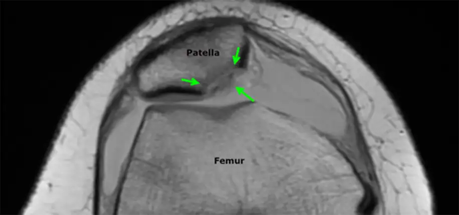 Ouch, my knee popped out!