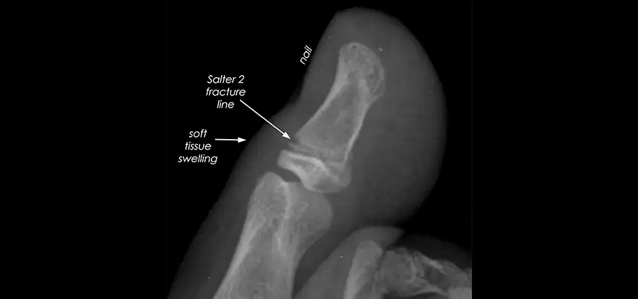 The Hidden Threat: The Stubbed Toe and Finger