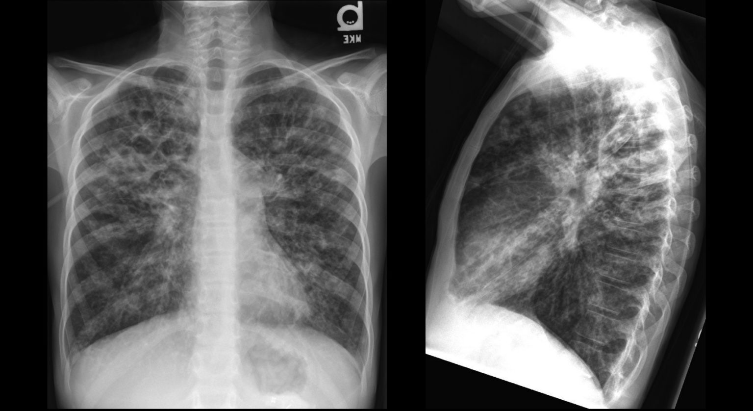 What Can a Chest Xray Show? Radiating Hope