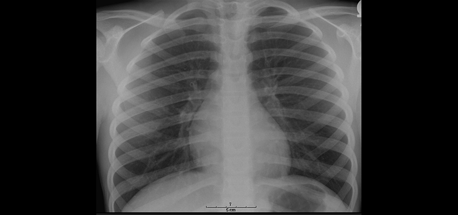 What Can a Chest X-ray Show?