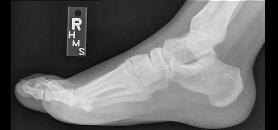 What are x-rays and how do they make a picture?