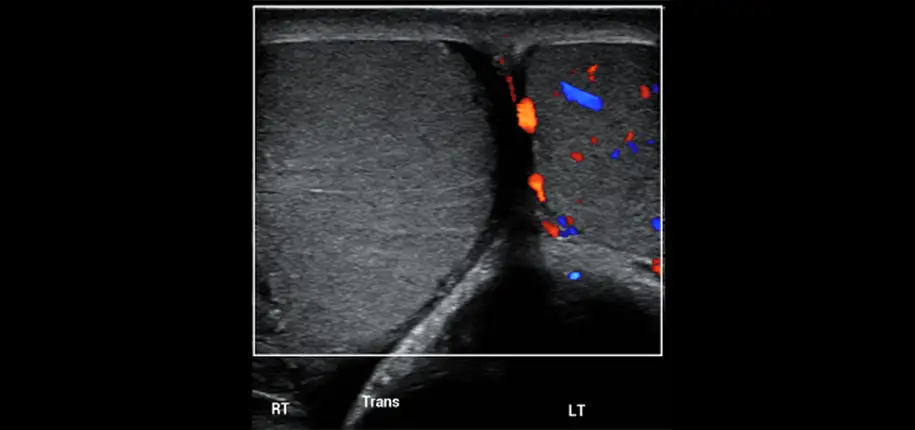 Diagnosing Urgent Cases Like Testicular Torsion
