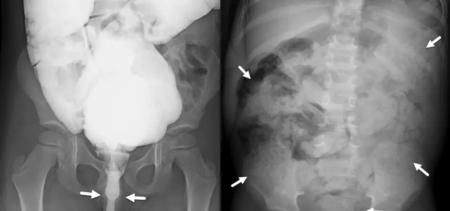 Diagnostic Contrast Enema for Chronic Constipation