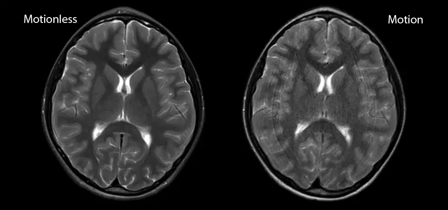 Answering Questions About the MRI Machine