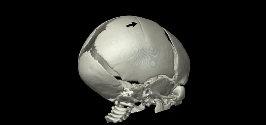 Head Trauma, Will my child need a head CT?