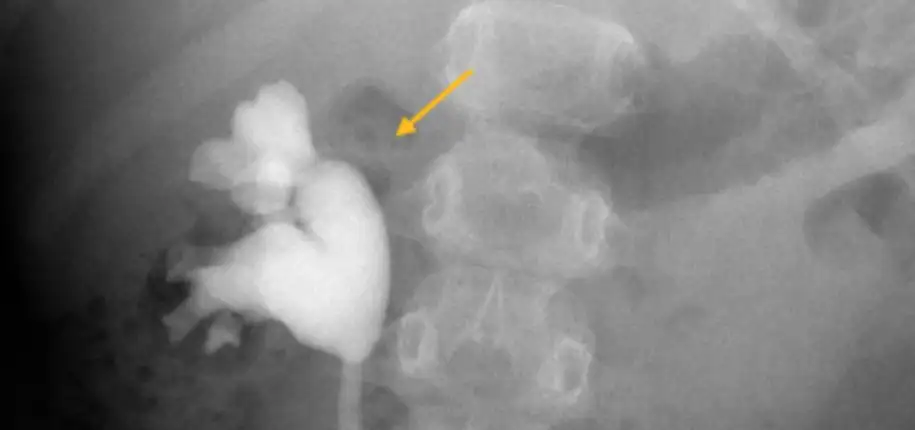 VCUG: What is reflux?