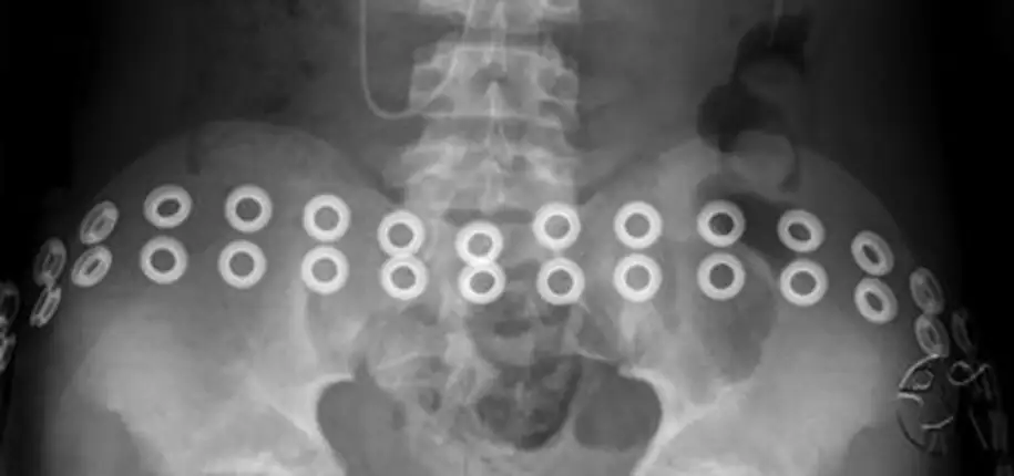 How-Tow Prepare For an X-Ray Exam