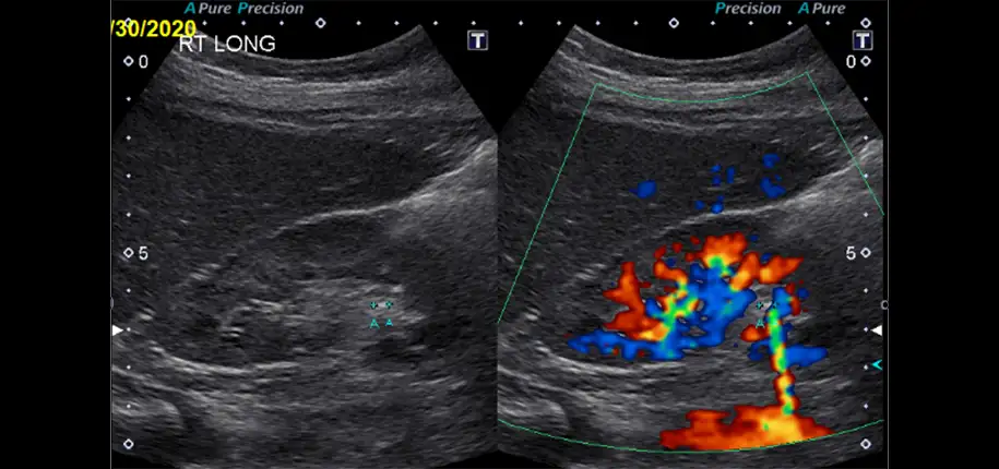What modalities are used to diagnose kidney stones and what modalities are not used to diagnose kidney stones?